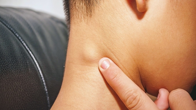 hạch hoại tử vùng cổ và những đều cần biết