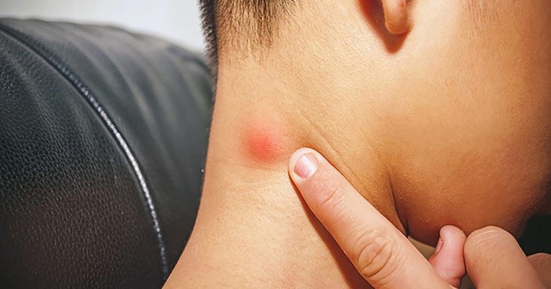 Giải đáp hạch thượng đòn bị viêm có gây nguy hiểm không? 2