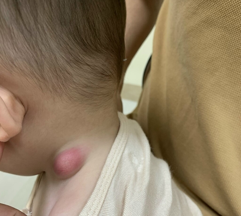 Hạch trung thất là gì? Các bệnh lý liên quan đến hạch trung thất 3