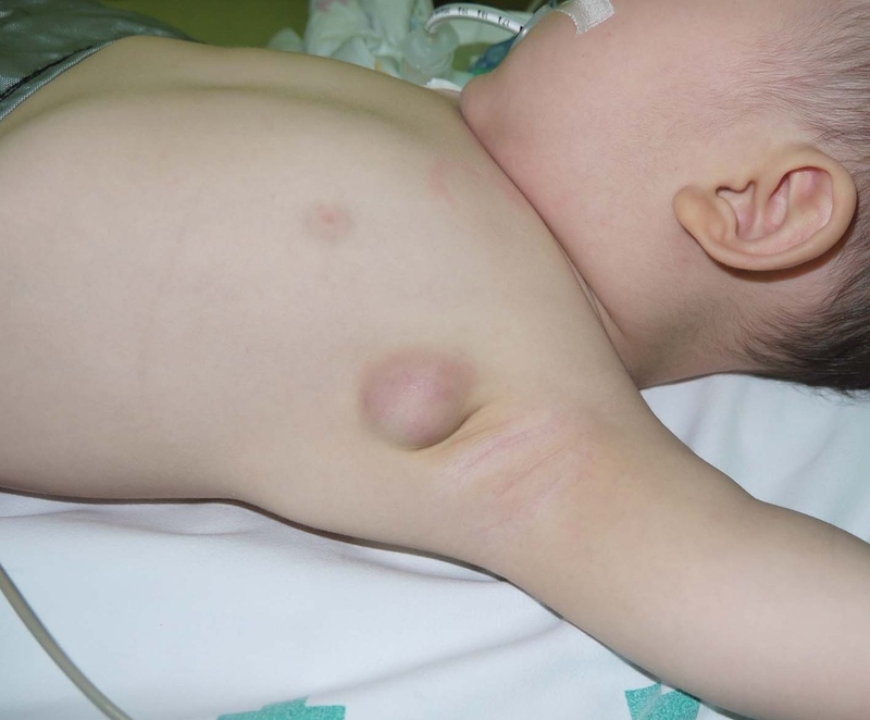 Hạch viêm mạn tính: N 1guyên nhân, triệu chứng, chẩn đoán và điều trị