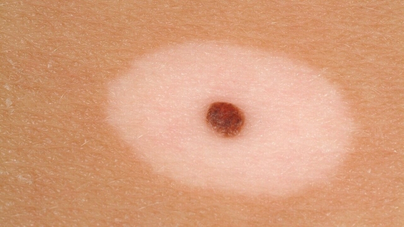 Halo nevus: Nguyên nhân, triệu chứng và cách điều trị 1