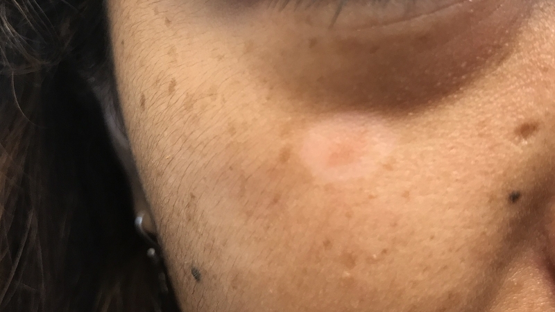 Halo nevus: Nguyên nhân, triệu chứng và cách điều trị 2