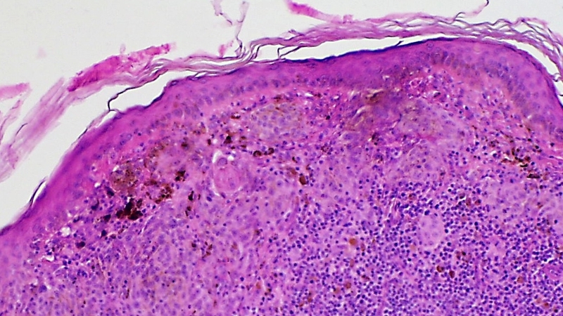 Halo nevus: Nguyên nhân, triệu chứng và cách điều trị 3