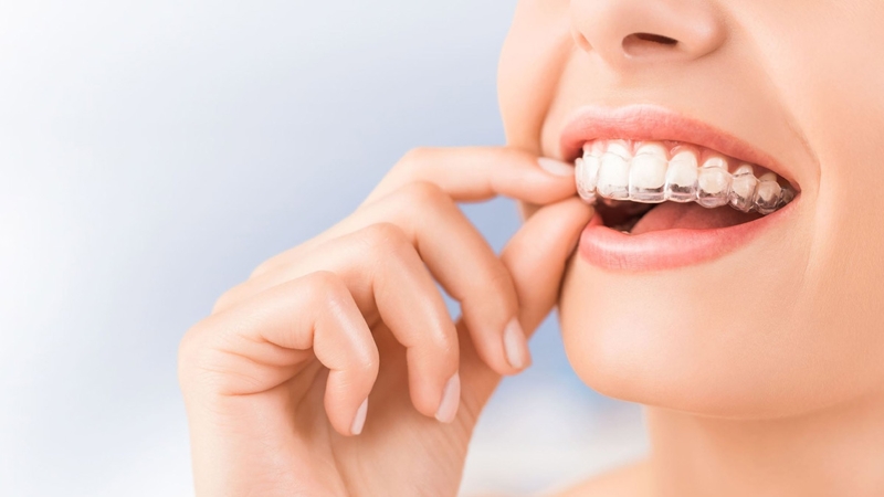 Hàm duy trì là gì và cần đeo bao lâu sau khi tháo niềng 2