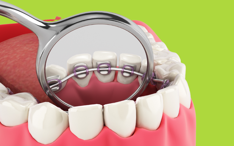 Hàm duy trì cố định mặt trong là gì? Có cấu tạo như thế nào? 1