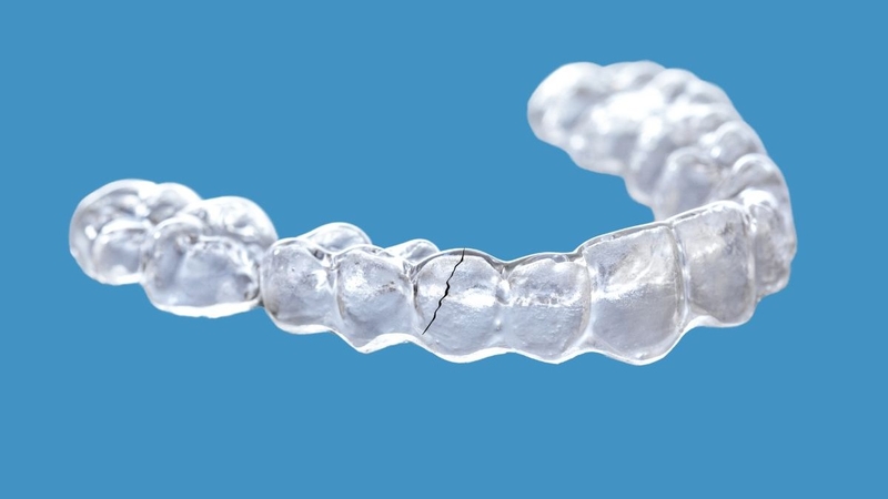 Hàm duy trì trong suốt bị nứt ảnh hưởng lớn đến kết quả chỉnh nha