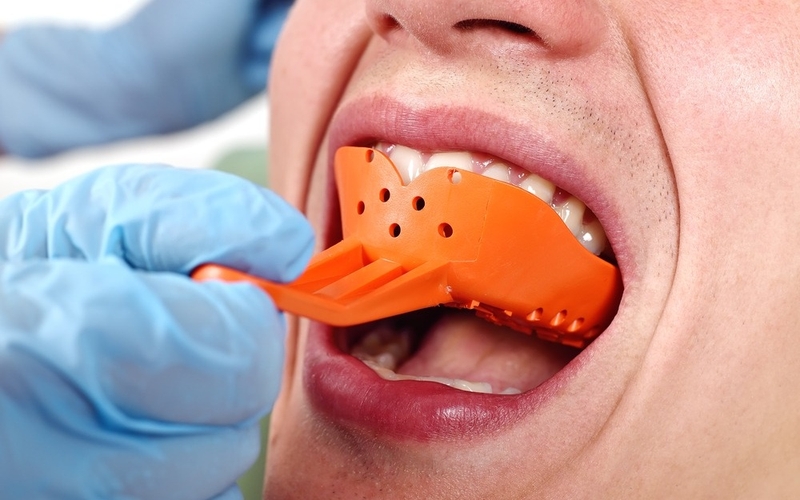 Hàm khung liên kết là gì? Hàm khung liên kết chia thành mấy loại? 3