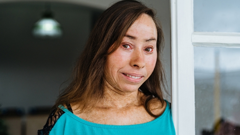 Harlequin ichthyosis là rối loạn da di truyền bẩm sinh hiếm gặp