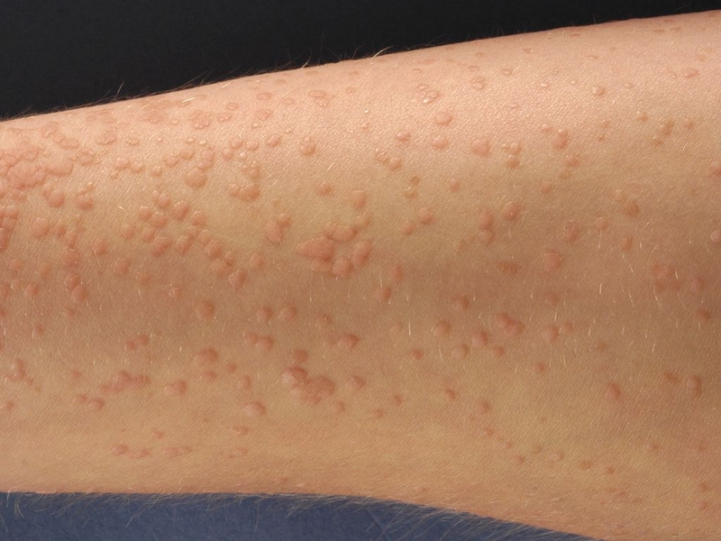 Hạt cơm phẳng là một dạng mụn cóc do virus HPV gây ra