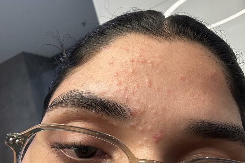 Bệnh khiến người bệnh cảm thấy kém tự tin khi mọc ở mặt hay tay