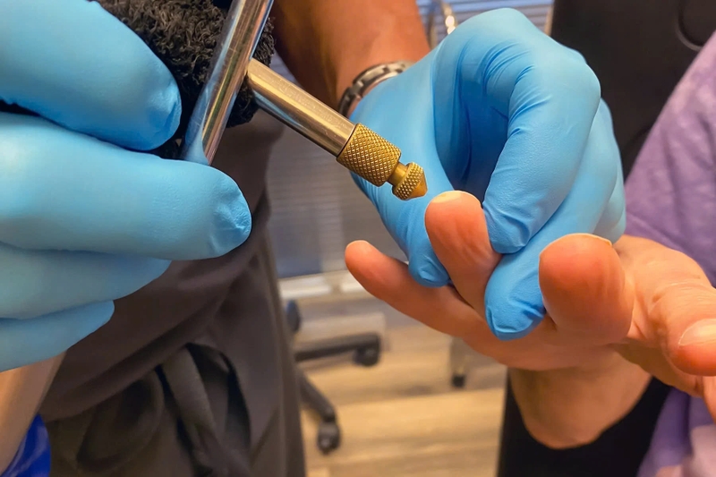 Cryotherapy là biện pháp làm đông lạnh hạt cơm bằng nitơ lỏng