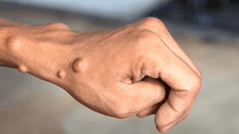 Hạt đậu dưới da: Giải đáp từ chuyên gia 1