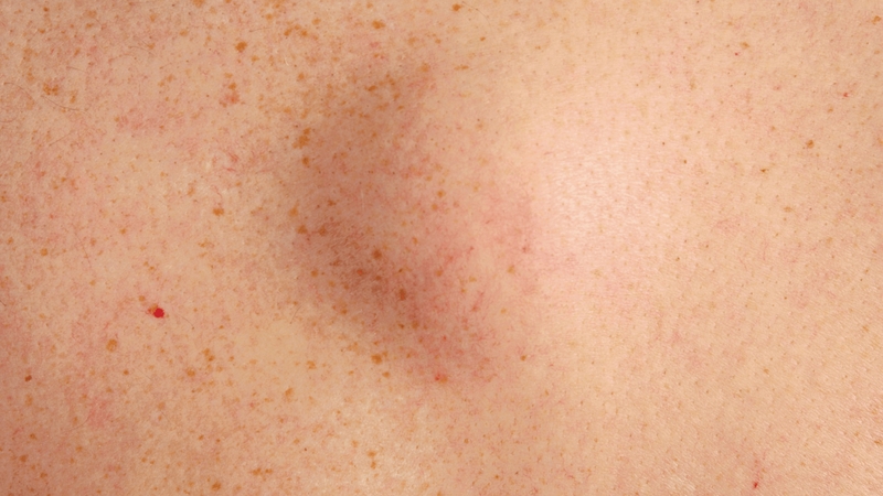 Hạt đậu dưới da: Giải đáp từ chuyên gia 2