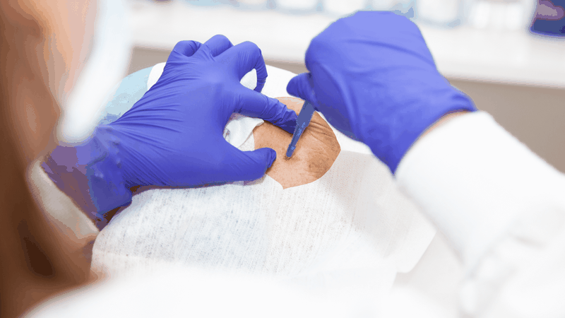 Hạt đậu dưới da: Giải đáp từ chuyên gia 4