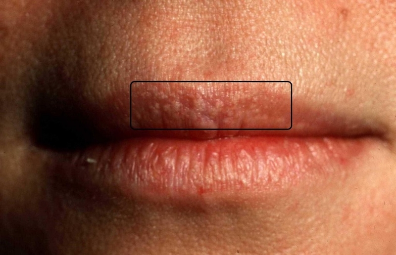 Hạt fordyce có tự khỏi không và những cách điều trị hiệu quả nhất 1