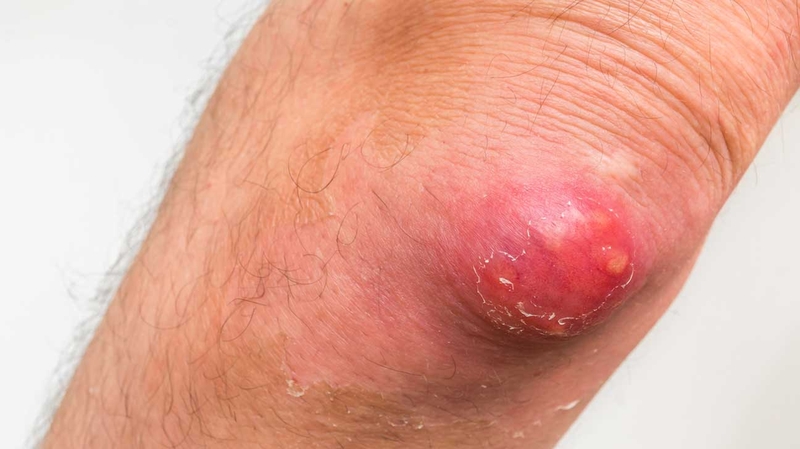 Hậu bối là bệnh gì? Có nguy hiểm không? Cách chữa thế nào 1