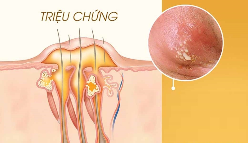 Hậu bối là bệnh gì? Có nguy hiểm không? Cách chữa thế nào 2