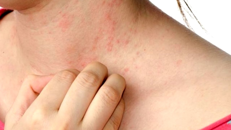 Tại sao hậu covid bị nổi mẩn đỏ? Điều trị như thế nào cho nhanh khỏi 1