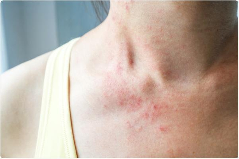 Tại sao hậu covid bị nổi mẩn đỏ? Điều trị như thế nào cho nhanh khỏi 2