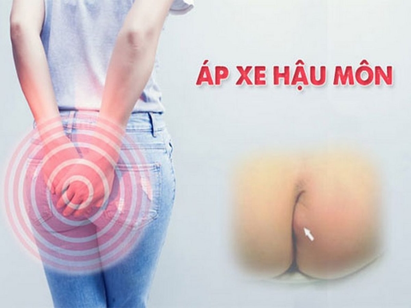 hậu môn bị sưng là bệnh gì