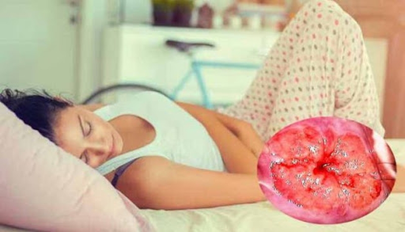 Hậu quả của viêm lộ tuyến cổ tử cung đến sức khỏe phụ nữ mà bạn không nên bỏ qua 2