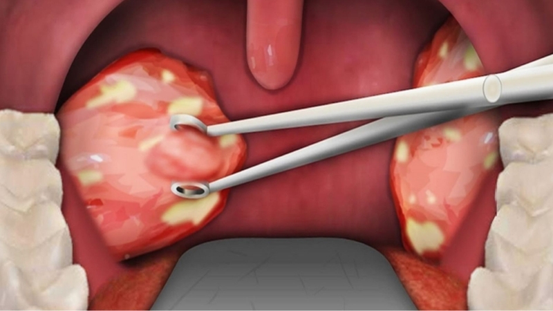 Hậu quả sau khi cắt amidan là gì được nhiều bệnh nhân quan tâm
