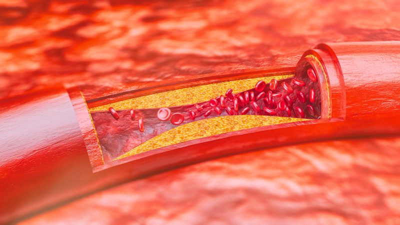 Hẹp động mạch chi dưới là gì? Những điều cần biết vể hẹp động mạch chi dưới 5.png