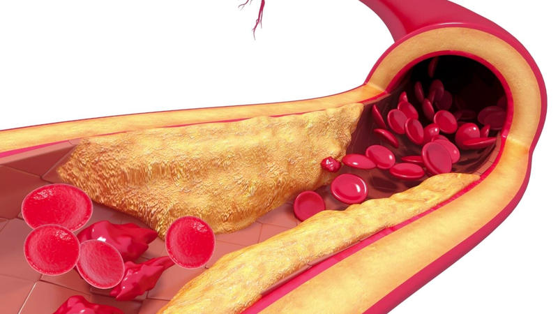 Hẹp động mạch thận là gì? Những điều cần biết về hẹp động mạch thận 4.png