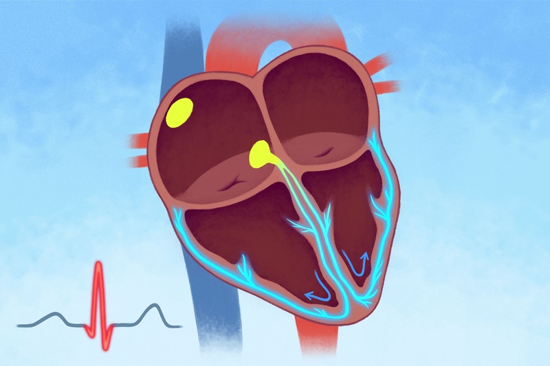 Hệ dẫn truyền có bất thường gây rối loạn nhịp tim