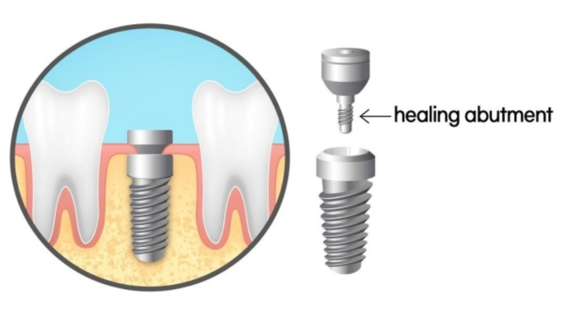 Healing implant là gì? Các đặc điểm nổi bật 1