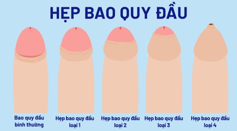 Hẹp bao quy đầu có quan hệ được không​? Các biện pháp cải thiện tình trạng hẹp bao quy đầu 1