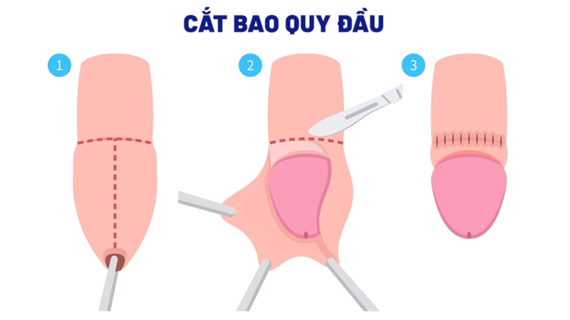 Hẹp bao quy đầu ở trẻ 3 tuổi: Nên làm gì? 3