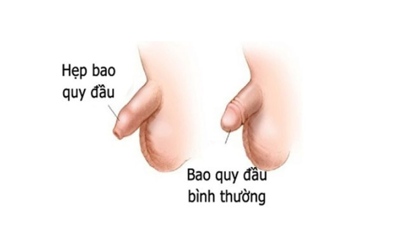 Hẹp bao quy đầu ở trẻ 3 tuổi: Nên làm gì? 3