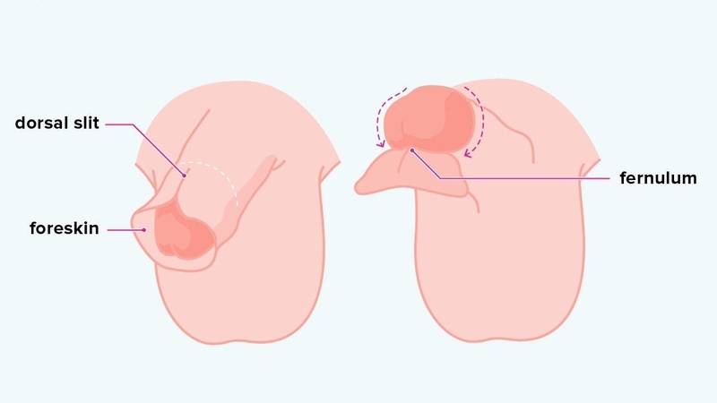 Hẹp bao quy đầu ở trẻ 4 tuổi: Nguyên nhân, triệu chứng, tác động và điều trị 1