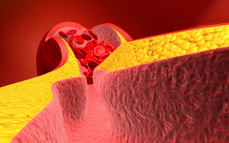 Hẹp mạch vành 30 - mức độ nhẹ nhưng không nên chủ quan 1