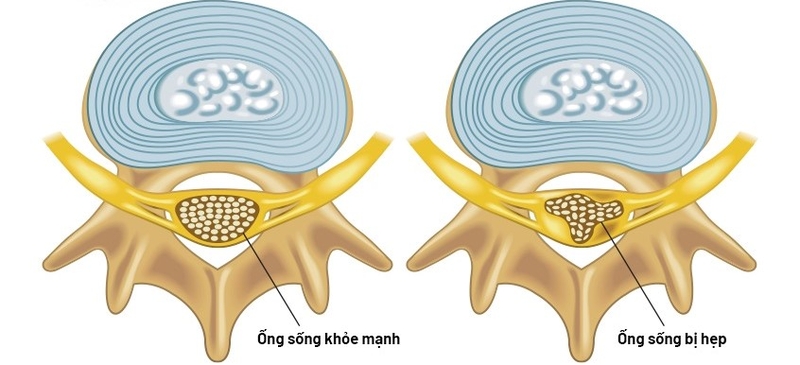 Giải đáp thắc mắc: Hẹp ống sống là gì và cách điều trị như thế nào?