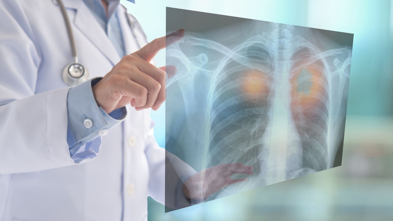 Ghép phổi là phương pháp điều trị cuối cùng khi bệnh nặng và không đáp ứng các cách khác, nhằm thay thế phổi và tĩnh mạch phổi bị tổn thương