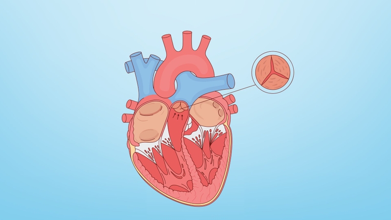 Hẹp van động mạch chủ​: Nguyên nhân, triệu chứng và phương pháp chẩn đoán 1