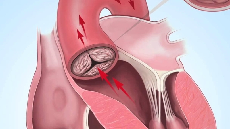 Hở van động mạch chủ 1/4 có đáng lo ngại? 4