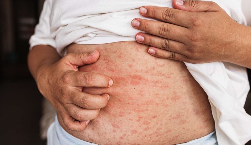 Muốn hết sốt nổi mẩn đỏ ở người lớn​, áp dụng ngay cách này 4