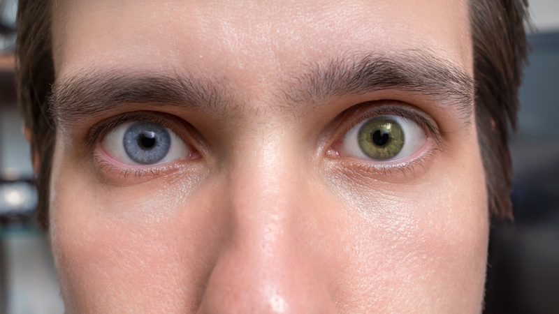 Ba dạng heterochromia được nhận biết qua sự phân bố màu sắc khác nhau ở mống mắt