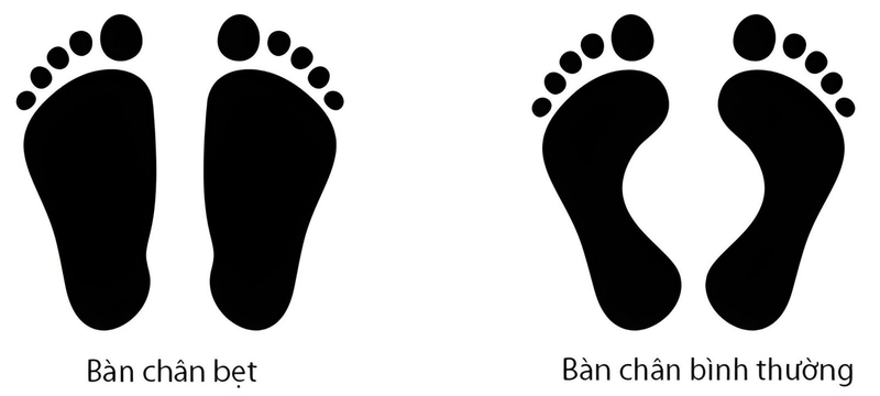 Hiện tượng bàn chân bẹt có biểu hiện gì? Phương pháp điều trị bàn chân bẹt ở trẻ em 1