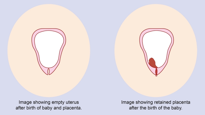 Hiện tượng băng huyết sau sinh 1 tháng là gì? Phải làm gì để phòng băng huyết sau sinh? 1
