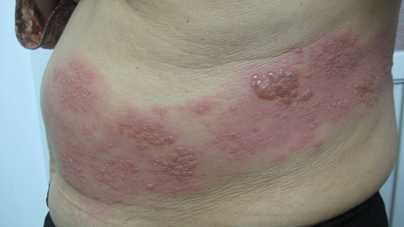 Dấu hiệu giúp nhận biết khi có hiện tượng bị giời leo 1