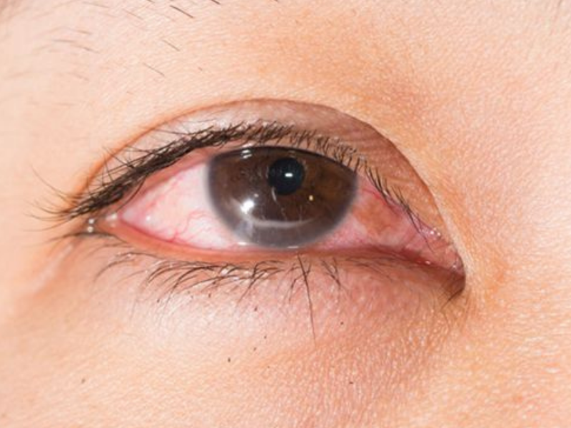 Hiện tượng mắt nhìn thấy đốm sáng là gì? 1