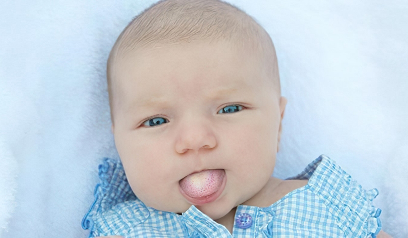 Hiện tượng nấm lưỡi ở trẻ sơ sinh là như thế nào?