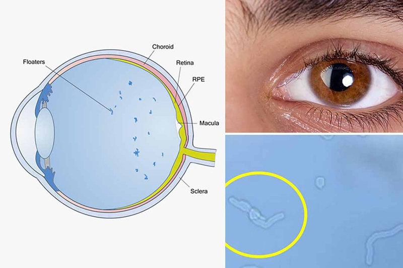 Hiện tượng ruồi bay sau khi mổ mắt: Nguyên nhân và điều trị 4