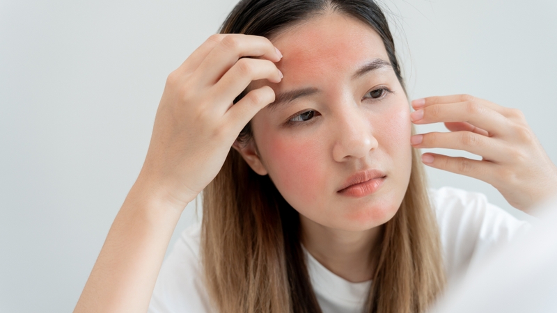 Hiện tượng sau khi peel da: Hiểu biết và cách xử lý để da phục hồi an toàn 5