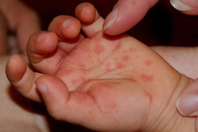 hiện tượng tay chân miệng-01