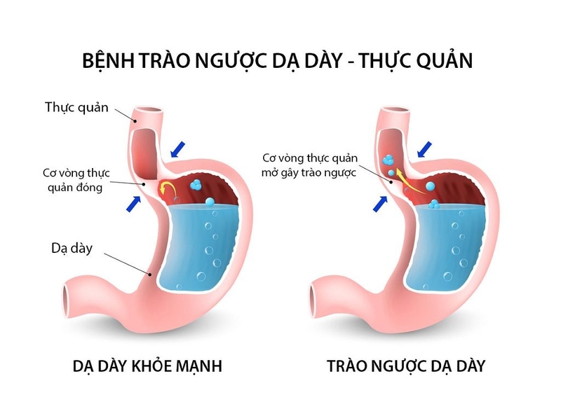 Hiện tượng trào ngược dạ dày: Nguyên nhân và cách chẩn đoán 2